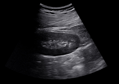 신장 초음파 사진