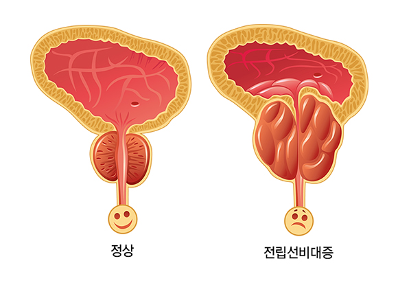 전립선 비대증